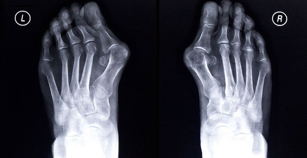 Radiographie de pied montrant la mesure des angles HV et DMAA pour évaluer la sévérité d'un hallux valgus